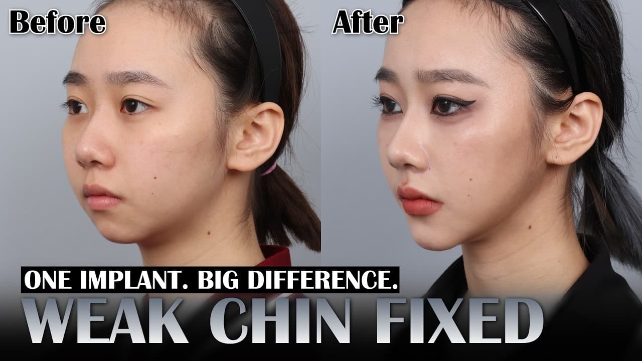How a Chin Implant Changed Her Profile ✨ K-Beauty, Refined.