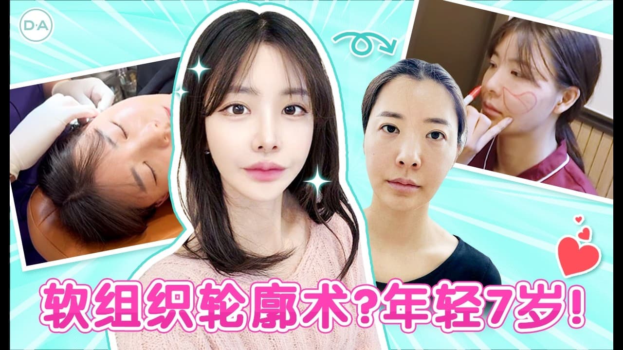 【韓國DA整形】軟組织輪廓術？年輕7歲！！！