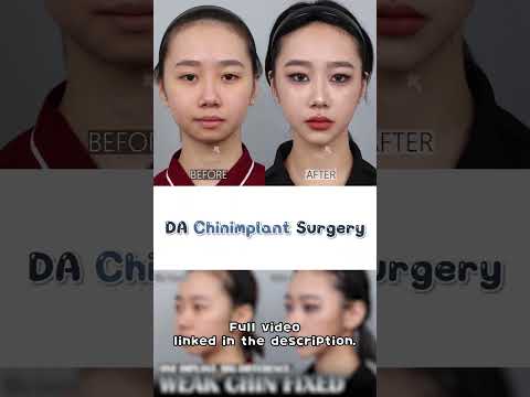 Preview: How a Chin Implant Changed Her Profile