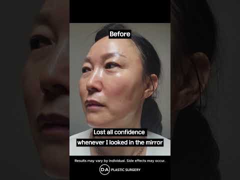 자연스럽고 우아하며 아름다운 | 미니 페이스리프트 전후 사진