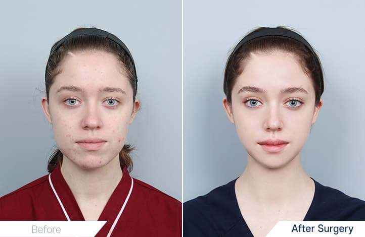 Square Jaw Surgery, Genioplasty