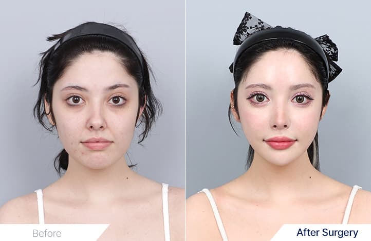 Rhinoplasty, Facial Contouring, Full Face Lifting