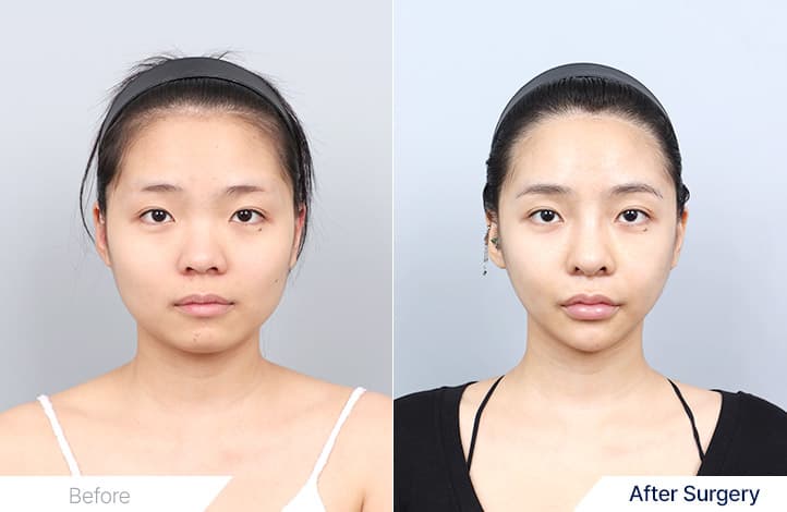Facial Contouring