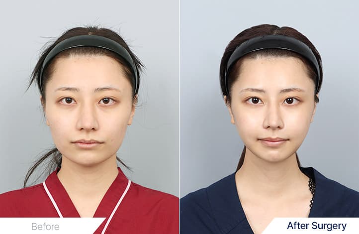 Facial Contouring