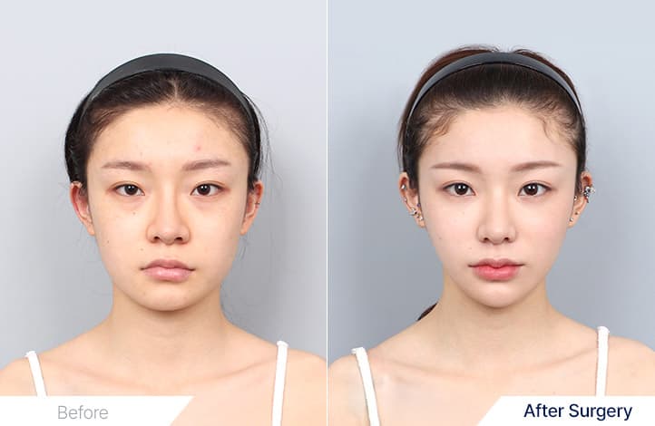 Facial Contouring, Rhinoplasty Bulbous Nose Correction, Breast Augmentaion, Fat Grafting