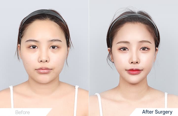 Zygomatic Reduction+Square Jaw Reduction+Chin Reduction Surgery+Accusculp