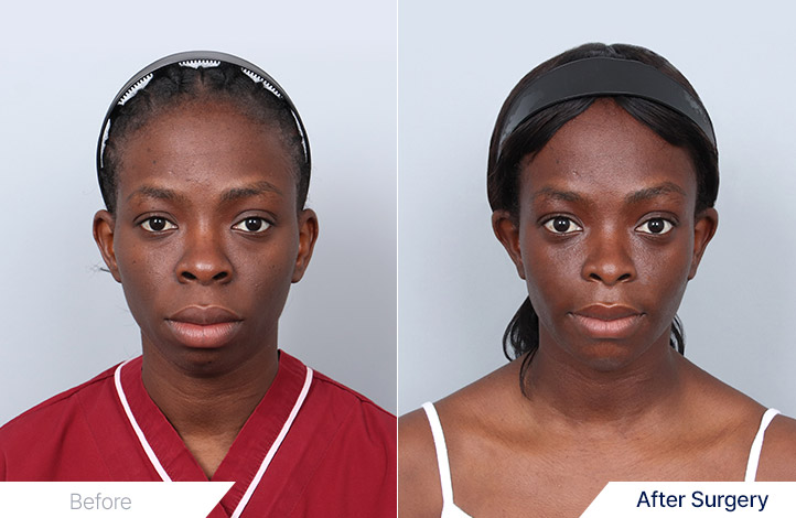 Facial Contour before and after