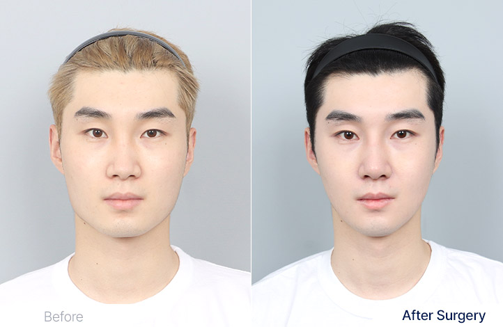 Facial Contour before and after