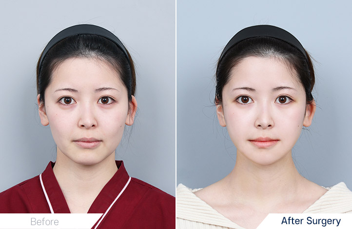 Facial Contour before and after