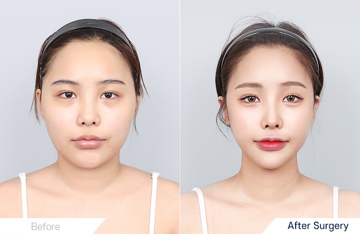 Facial Contour before and after