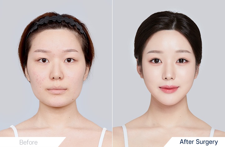 Facial Contour before and after