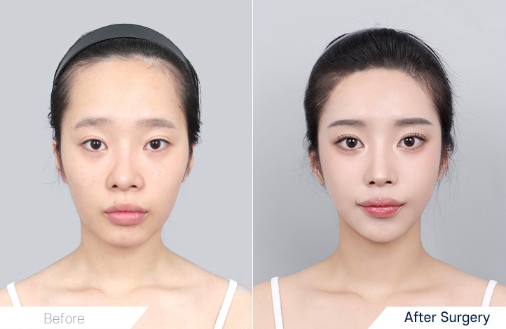 Facial Contour before and after