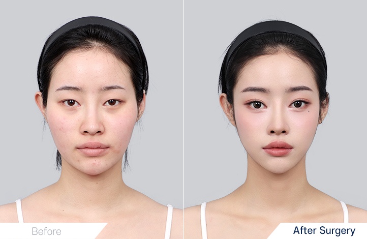 Facial Contour before and after