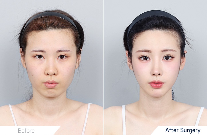 Facial Contour before and after