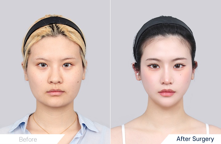 Facial Contour before and after