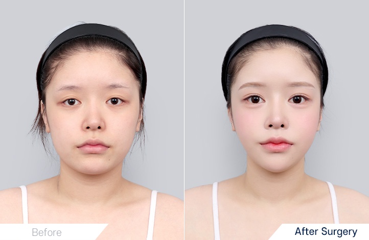 Facial Contour before and after