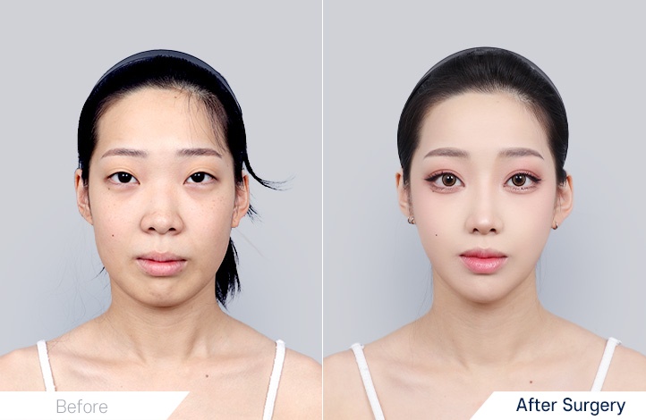 Facial Contour before and after