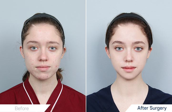 Facial Contour before and after
