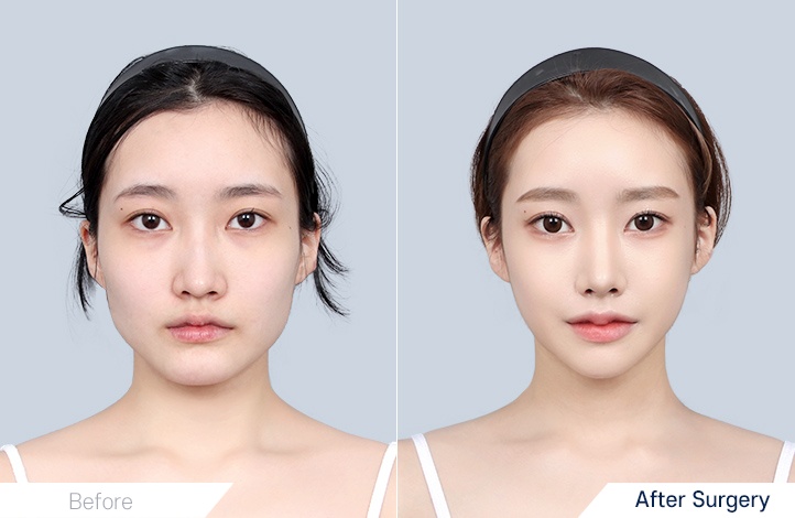 Facial Contour before and after