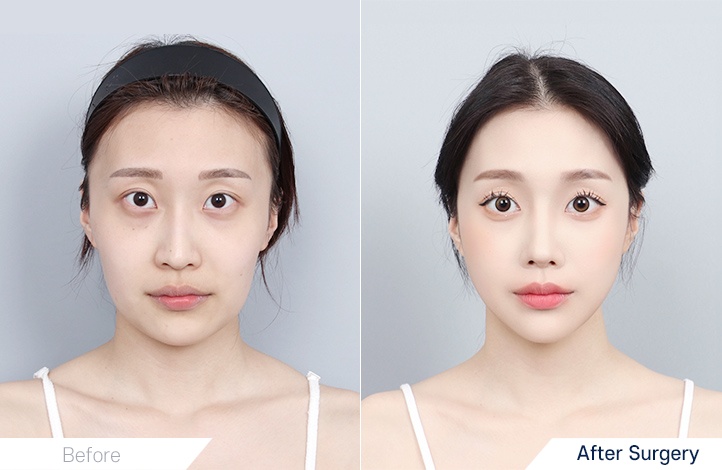 Facial Contour before and after