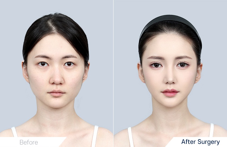 Facial Contour before and after