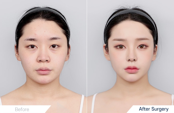 Facial Contour before and after