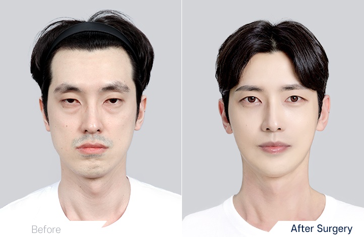 Facial Contour before and after