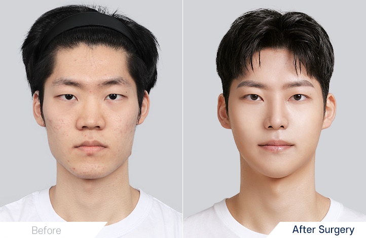 Facial Contour before and after