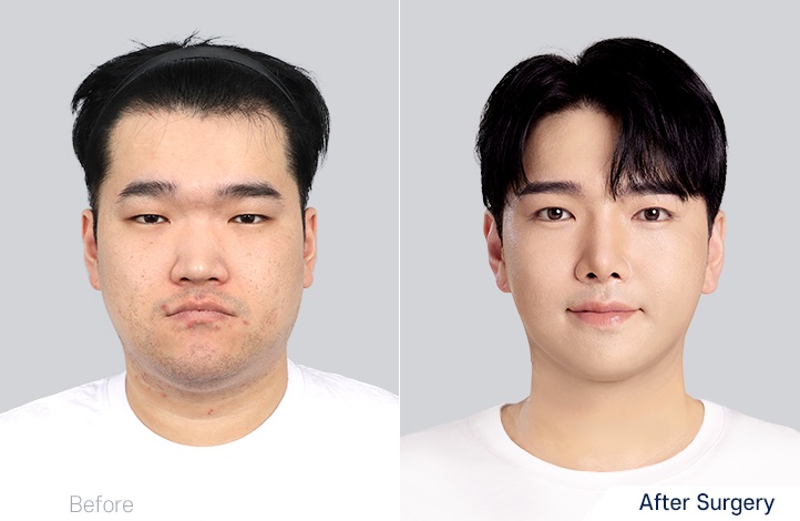 Facial Contour before and after