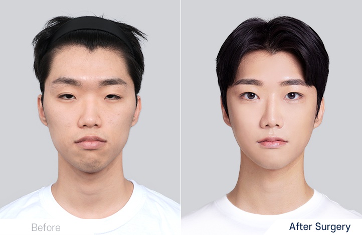 Facial Contour before and after