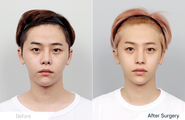 Facial Contour before and after