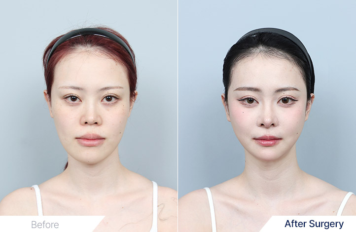 Facial Contour before and after