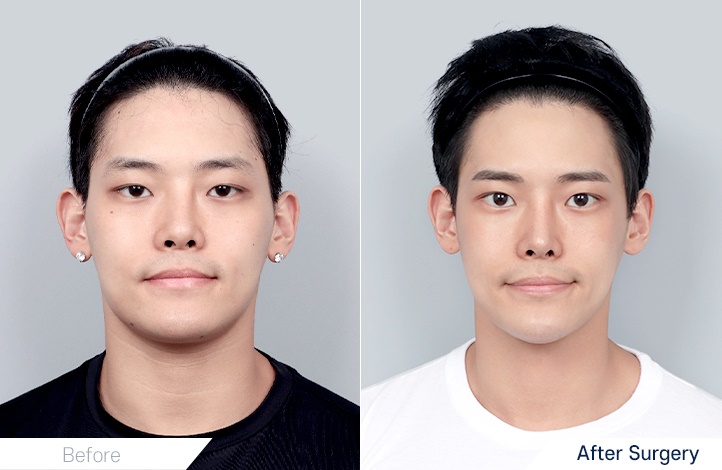 Facial Contour before and after