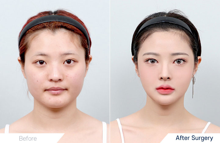 Facial Contour before and after