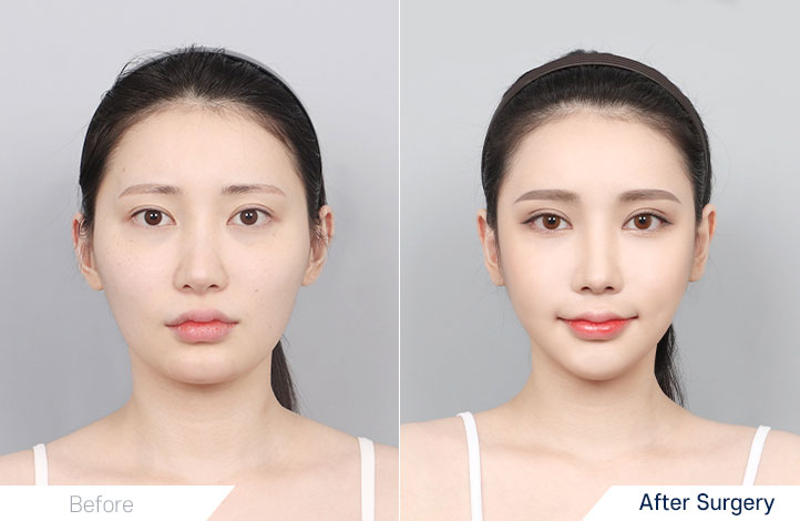 Facial Contour before and after