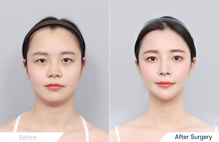 Facial Contour before and after
