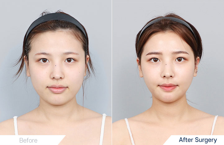 Facial Contour before and after