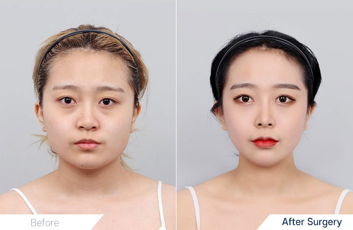 Facial Contour before and after