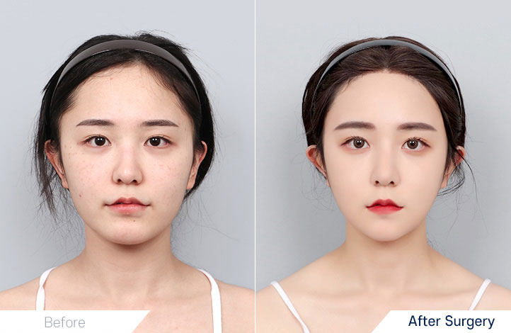 Facial Contour before and after
