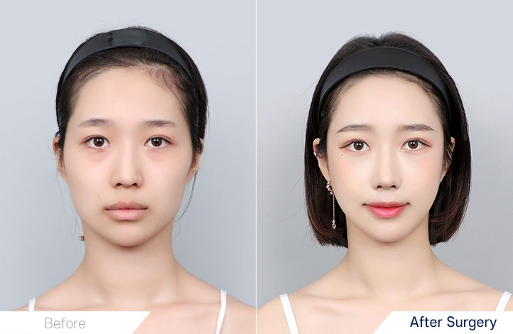 Facial Contour before and after