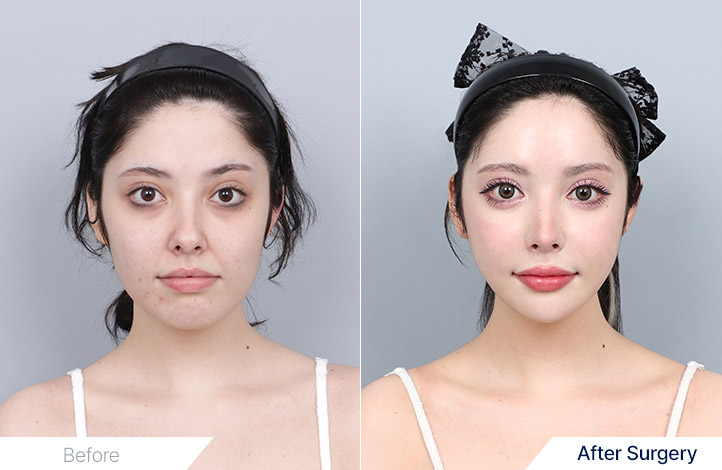 Facial Contour before and after