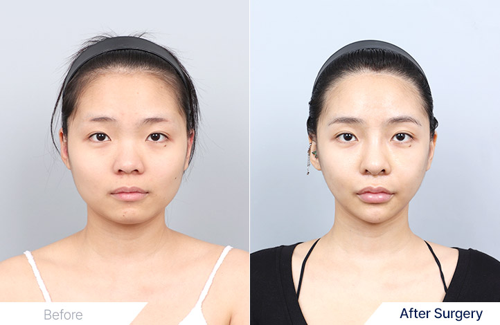 Facial Contour before and after