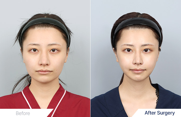 Facial Contour before and after