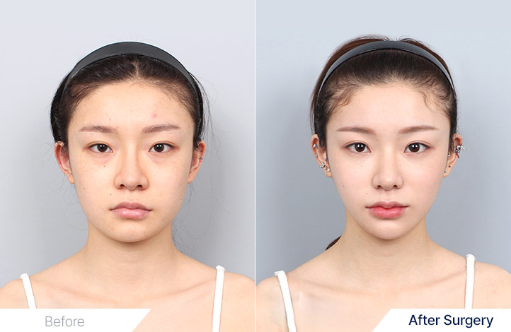 Facial Contour before and after