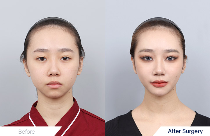 Facial Contour before and after