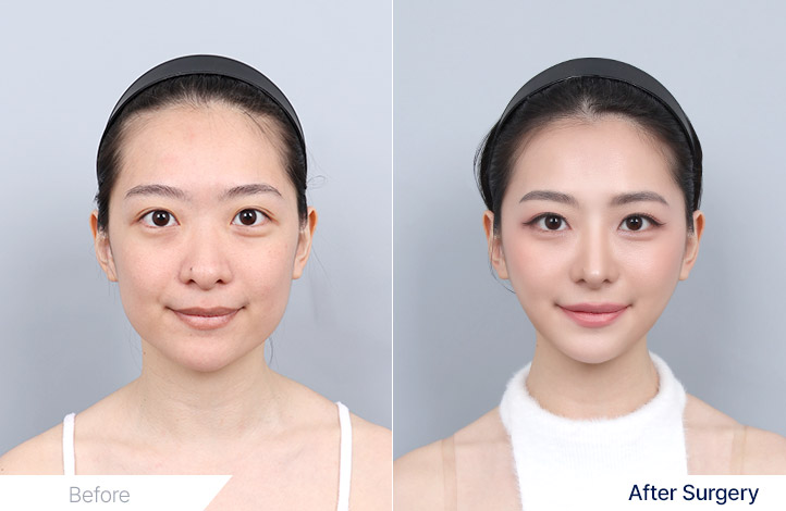 Facial Contour before and after